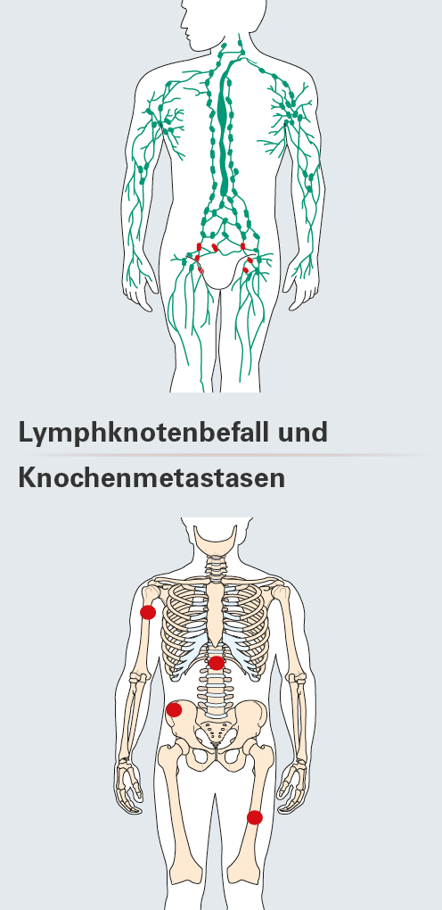 Lymphknotenmetastasen